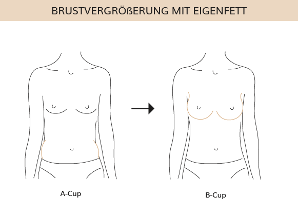 Brustvergrosserung Mit Eigenfett In Karlsruhe Dr Weihrauch